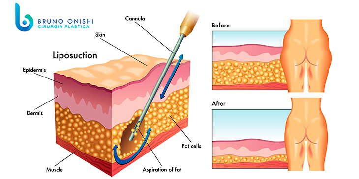 Lipoaspiração: tire todas as suas dúvidas sobre essa cirurgia plástica